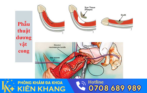 Biến chứng cong dương vật do kỹ thuật khâu không đúng cách