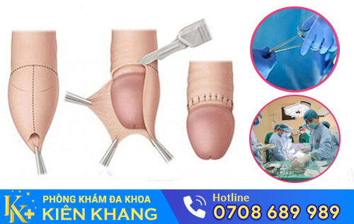 Phương pháp hỗ trợ điều trị đau buốt quy đầu hiệu quả