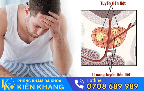 u nang tuyến tiền liệt