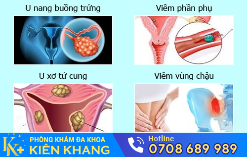 Biểu hiện viêm vùng chậu, viêm phần phụ, u xơ tử cung, u nang buồng trứng