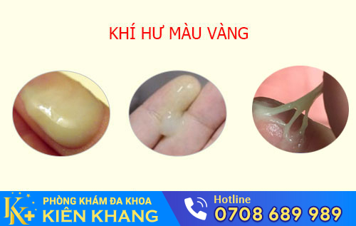 Khí hư màu vàng
