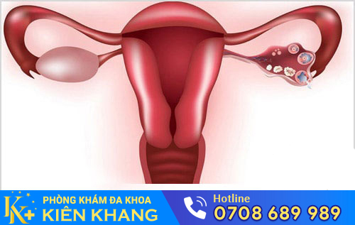 Hình ảnh bệnh viêm phần phụ