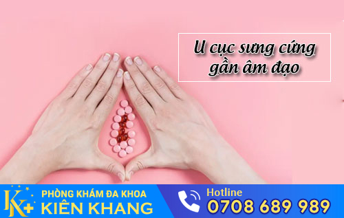 U cục sưng cứng gần âm đạo