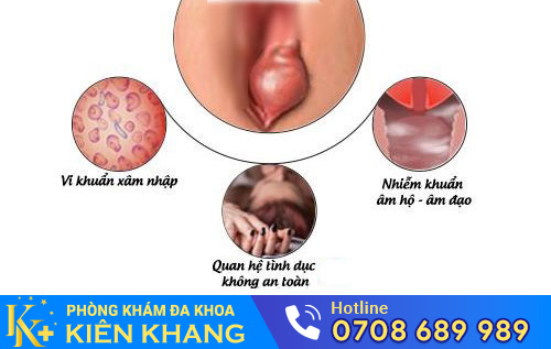 Viêm tuyến bartholin