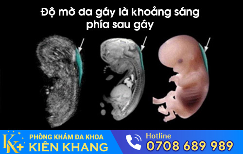 độ mờ da gáy