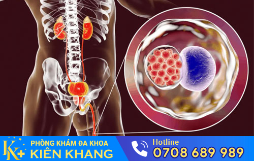 Bệnh Chlamydia