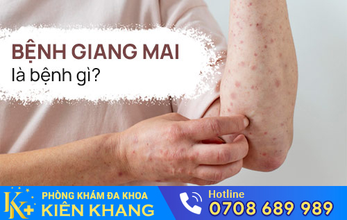 benh giang mai la benh gi