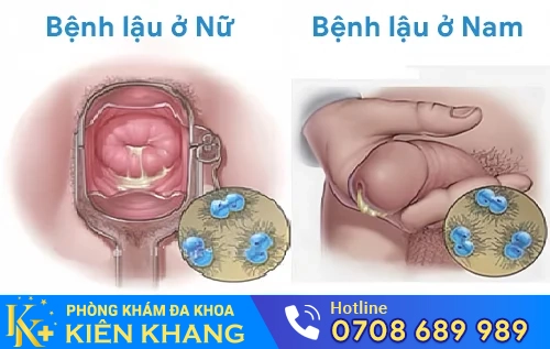 benh lau la gi