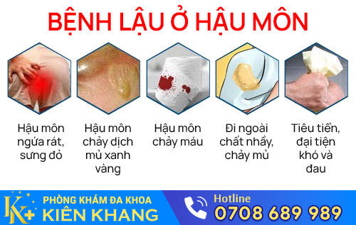 benh lau o hau mon
