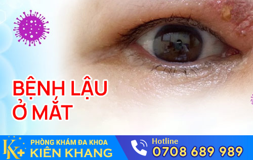 benh lau o mat