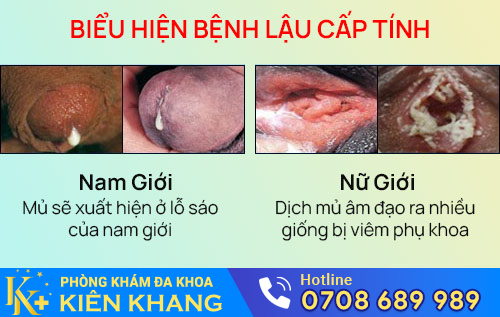 bieu hien benh lau cap tinh