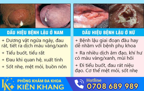 Biểu hiện của bệnh lậu
