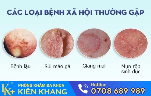 cac benh xa hoi thuong gap