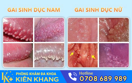 Gai sinh dục