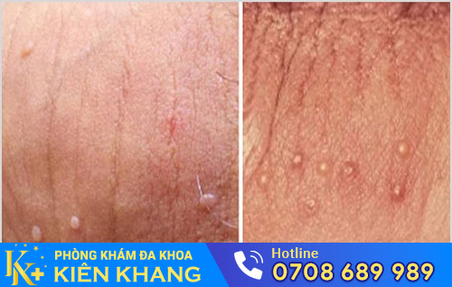 Hình ảnh sùi mào gà ở nam giai đoạn đầu