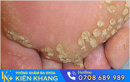 Các nốt u nhú mào gà ở chân
