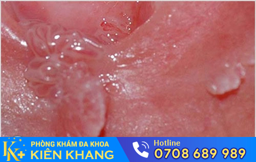 Hình ảnh sùi mào gà ở nữ giai đoạn đầu