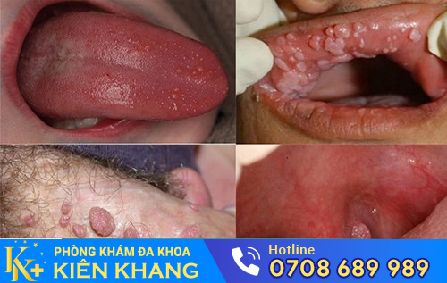Sùi mào gà ở vòm họng