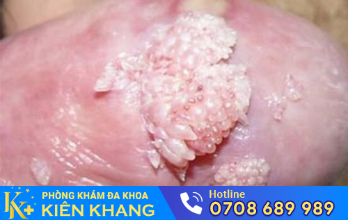 Hình ảnh sùi mào gà ở rãnh quy đầu