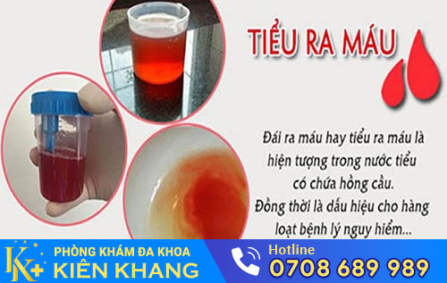 Nguyên nhân gây tiểu buốt ra máu