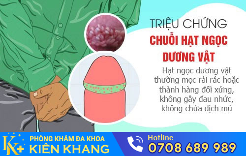 Triệu chứng của chuỗi hạt ngọc dương vật