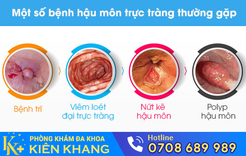 Một số bệnh hậu môn, trực tràng thường gặp