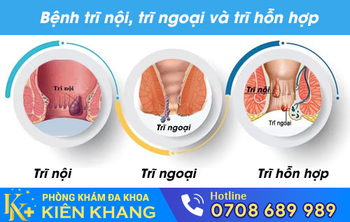 Các loại bệnh trĩ