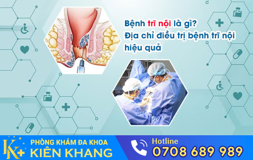 Địa chỉ điều trị bệnh trĩ nội hiệu quả
