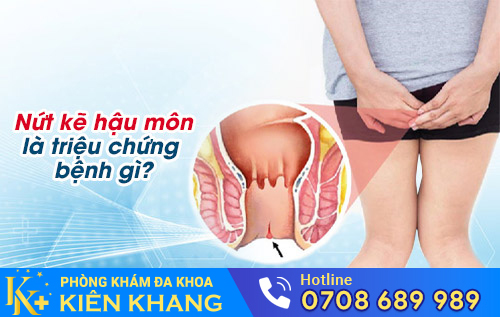 Nứt kẽ hậu môn là triệu chứng bệnh gì?