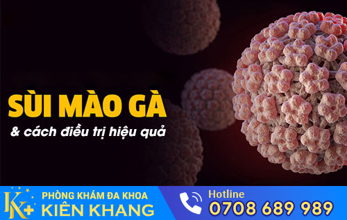 Sùi mào gà