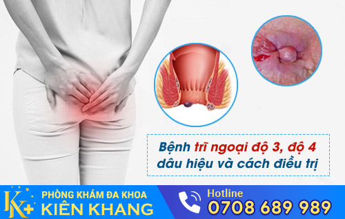 Trĩ ngoại độ 3 độ 4